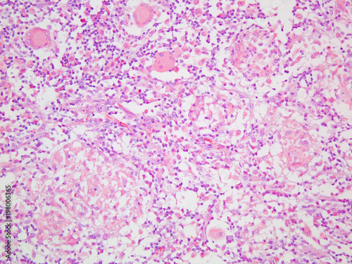 Crohns Disease granuloma in the small intestine viewed at 200x magnification with haemotoxylin and eosin staining photo
