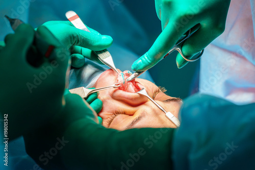 Plastic surgery of the nose in operating room, rhinoplasty photo
