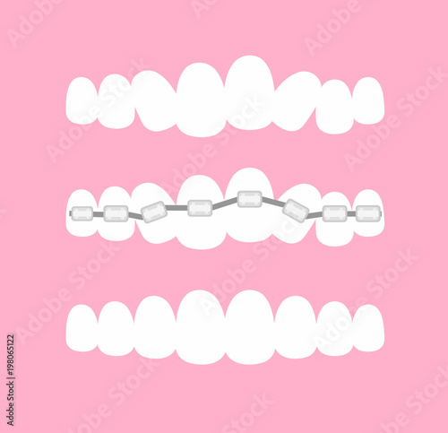 Vector illustration of the stages of orthodontic treatment braces on teeth . Teeth before and after braces on pink background in flat cartoon style.