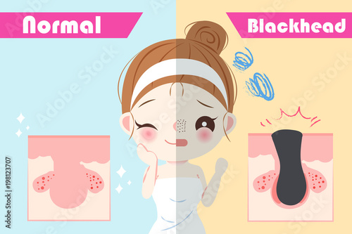 beauty woman with blackhead problem