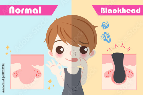 man with blackhead problem