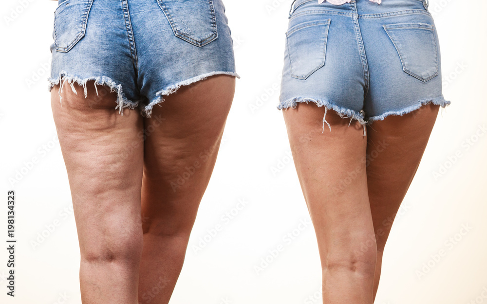 Comparison of legs with and without cellulite