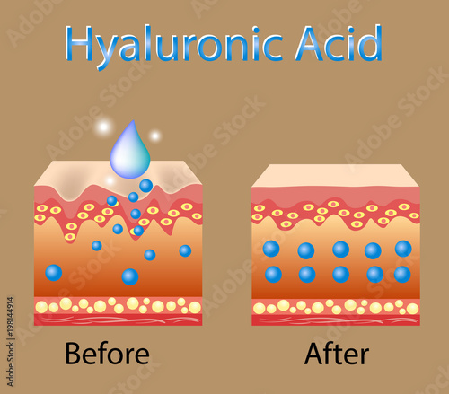 Vector illustration with process of getting skin younger with help of hyaluronic acid