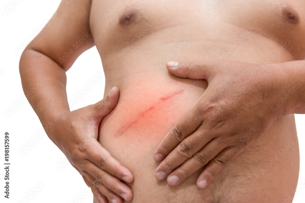 fat man with scar after surgery on abdomen, removal of appendicitis.