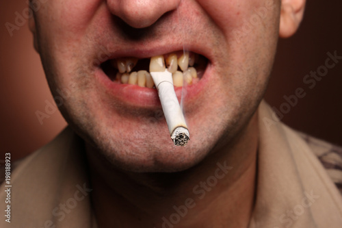 bad teeth smoker