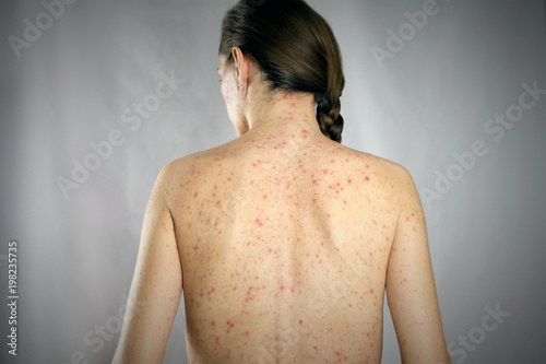 treatment eczema  concept. girls back skin rashes photo