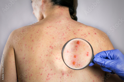 Foto medical research chickenpox viral infection concept