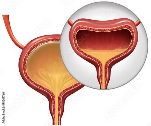 Overactive Bladder photo