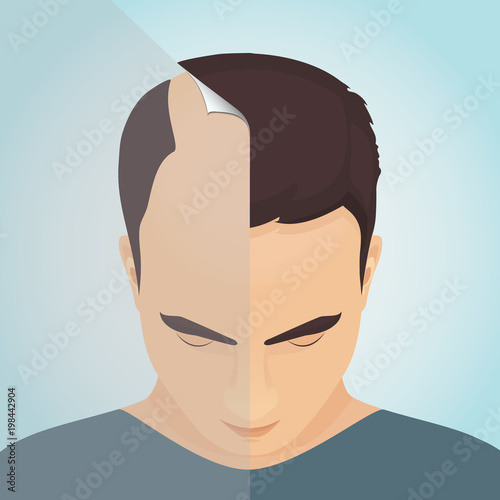 Top view portrait of a man before and after hair treatment and transplantation. Divided image of the head. Two halves. Sticker revealing healthy scalp. Isolated vector illustration.