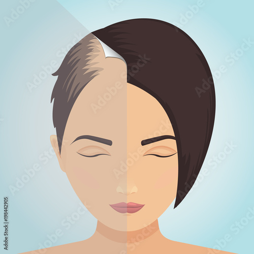 Front view of a balding woman before and after hair treatment. Divided image of the head. Two halves. Sticker revealing healthy scalp. Female alopecia. Isolated vector illustration.