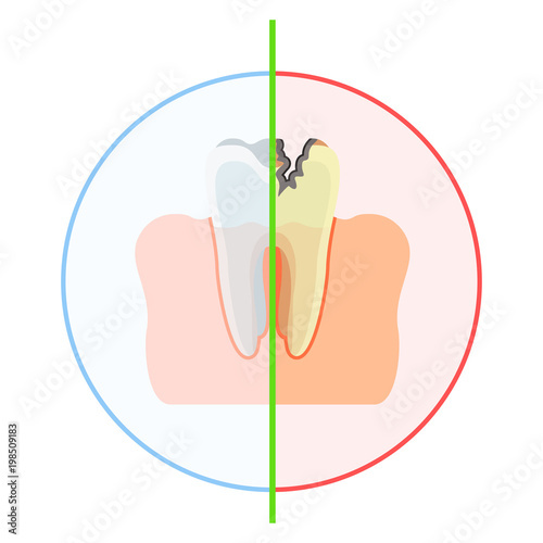 Tooth is healthy and damaged by caries, with hole. Flat vector cartoon illustration. Objects isolated on white background.