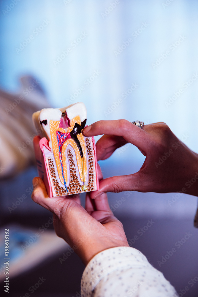hands holding a human tooth model with tooth decay hands holding a human tooth model with tooth decay