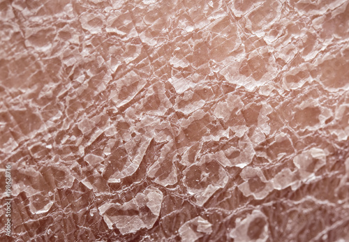 unhealthy human skin epidermis texture with flaking and cracked particles close-up photo