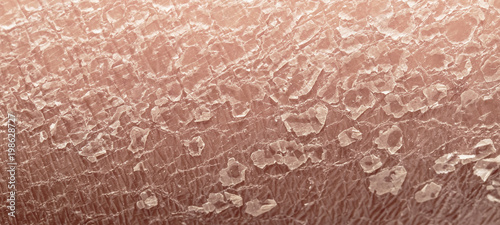  human skin epidermis texture with flaking and cracked particles close-up photo