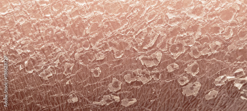 Tableau sur toile human skin epidermis texture with flaking and cracked particles close-up