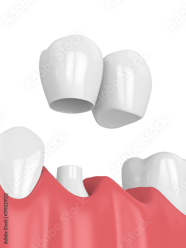 3d render of jaw with dental cantilever bridge