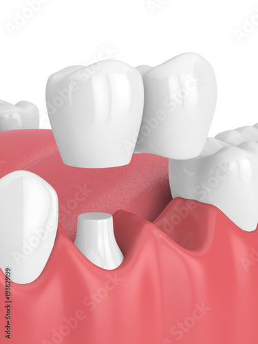 Photos 3d render of jaw with dental cantilever bridge