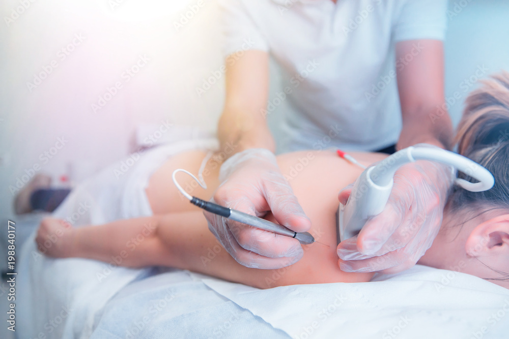 Φωτογραφία Ultrasound assisted ecography intratissue percutaneous electrolysis dry needling physical therapy rehabilitation physiotherapist treatment machine in hospital medical center IPE physiotherapy clinic