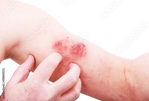 Atopic dermatitis (AD), also known as atopic eczema, is a type of inflammation of the skin (dermatitis) at foot.