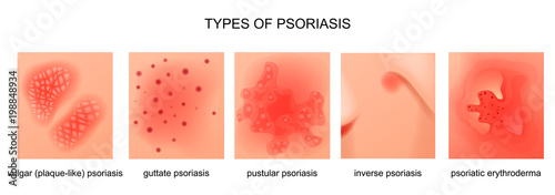 types of psoriasis photo