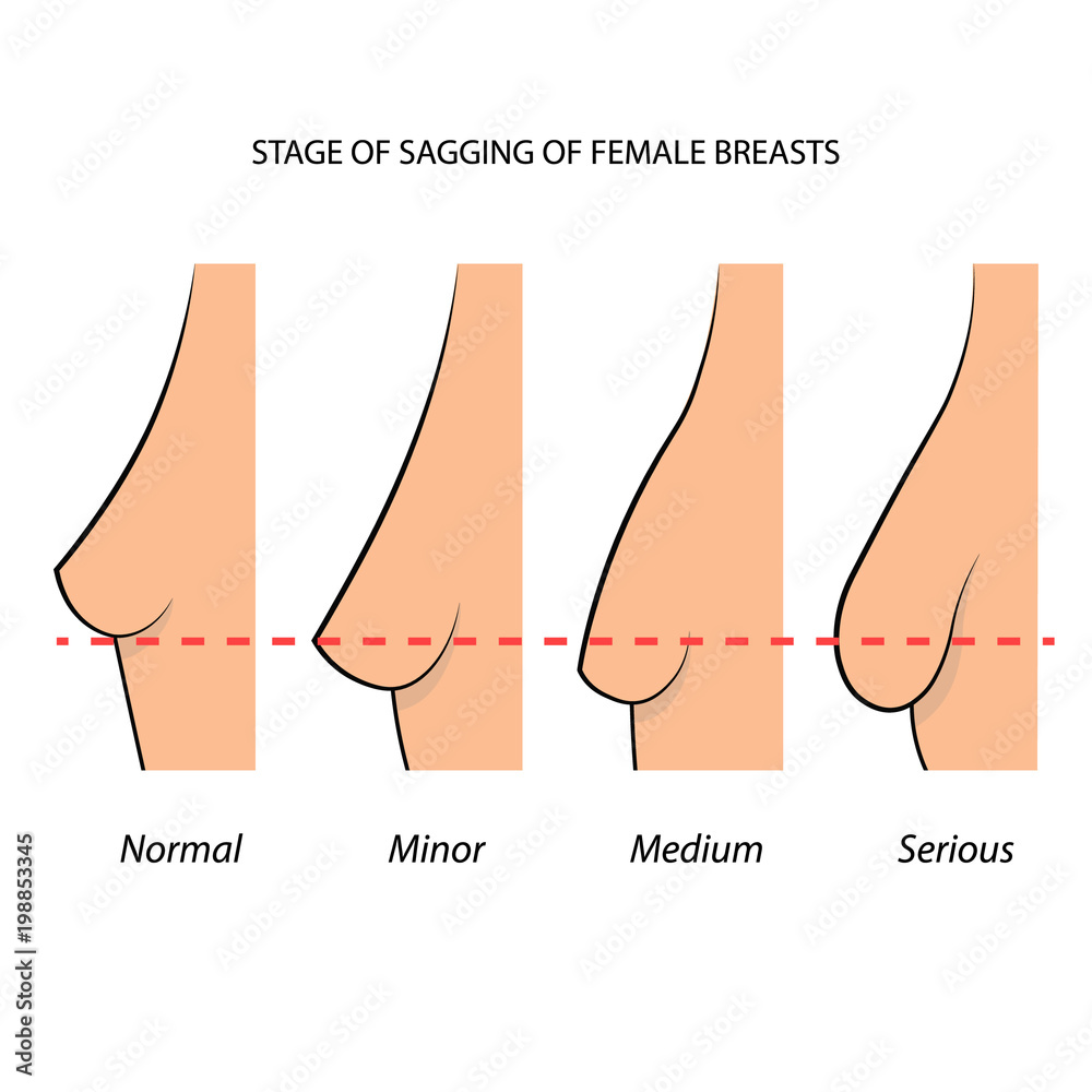 Stage of sagging of female breasts, information graphic. Vector  illustration. Stock Vector