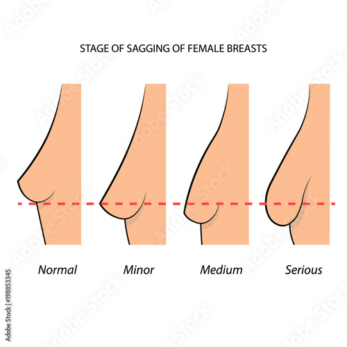 Stage of sagging of female breasts, information graphic. Vector illustration.