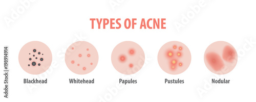 Types of acne diagram illustration vector on white background, Beauty concept. photo