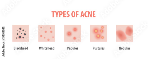 Types of acne diagram illustration vector on white background, Beauty concept.