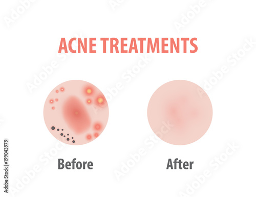 Acne treatments diagram illustration vector on white background, Beauty concept.