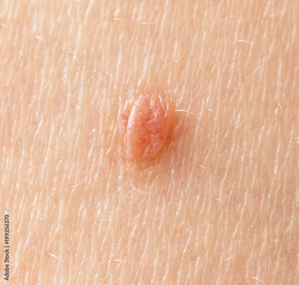 Fototapeta premium birthmark on skin