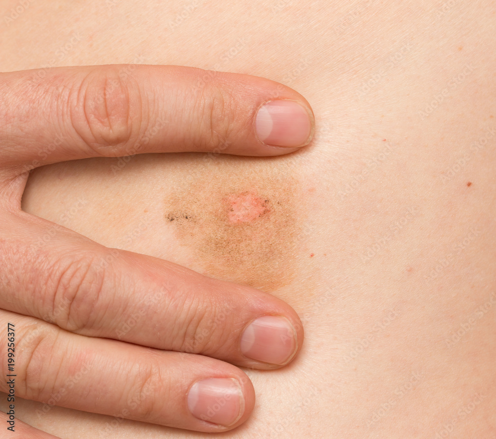 Fototapeta premium Ringworm on the body