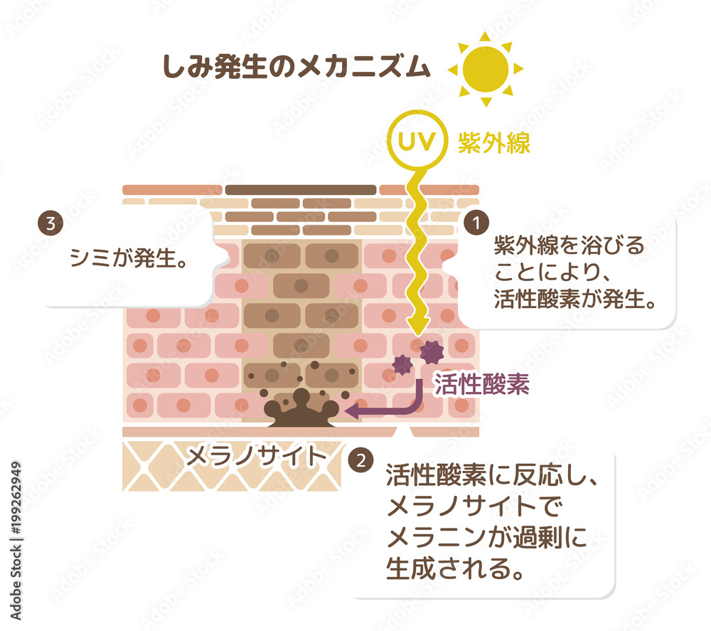 しみ発生のメカニズムイラスト 解説文つき Stock Vector Adobe Stock