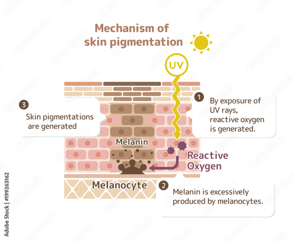 Mechanism Of Skin Pigmentation / Skin Spot Illustration (with ...