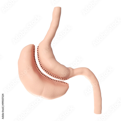 Konstfotografi 3d rendered medically accurate illustration of a vertical sleeve gastrectomy