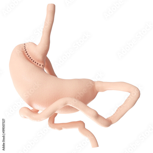 Fotografie 3d rendered medically accurate illustration of a gastric bypass