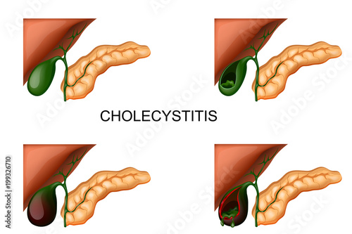 liver, gall bladder and pancreas. cholecystitis photo