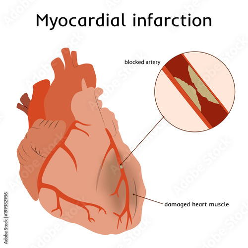 Myocardial infarction. Heart attack. Blocked artery, damaged heart muscle. Anatomy flat illustration. Red image, white background.