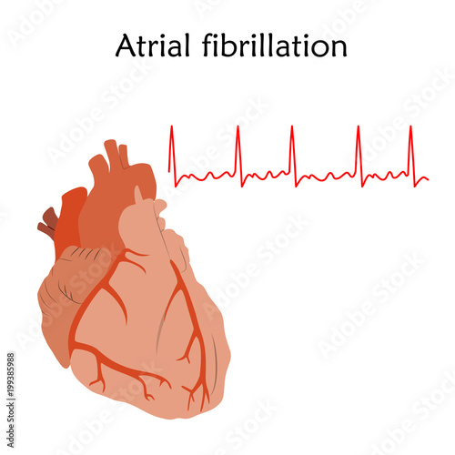 Human heart. Atrial fibrillation. Anatomy flat illustration. Red image, white background. Heartbeat, pulse.
