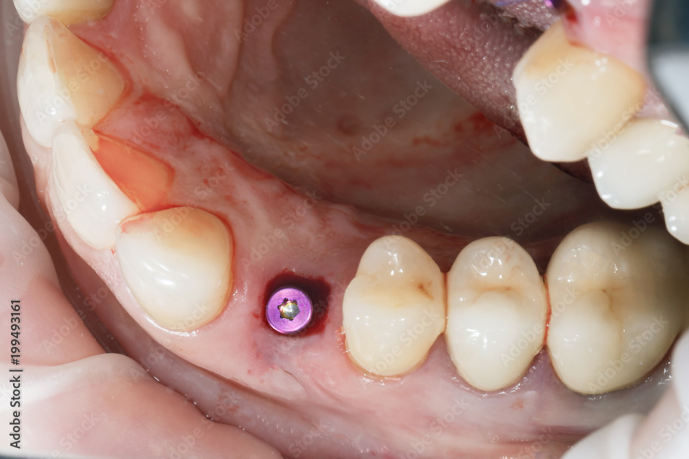 gum with installed implant and violet color abutment