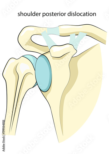 Shoulder posterior dislocation