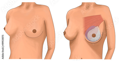 Fotografi Breast augmentation