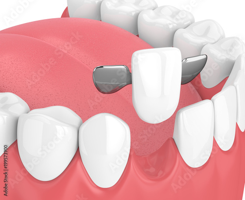 3d render of jaw with teeth and maryland bridge