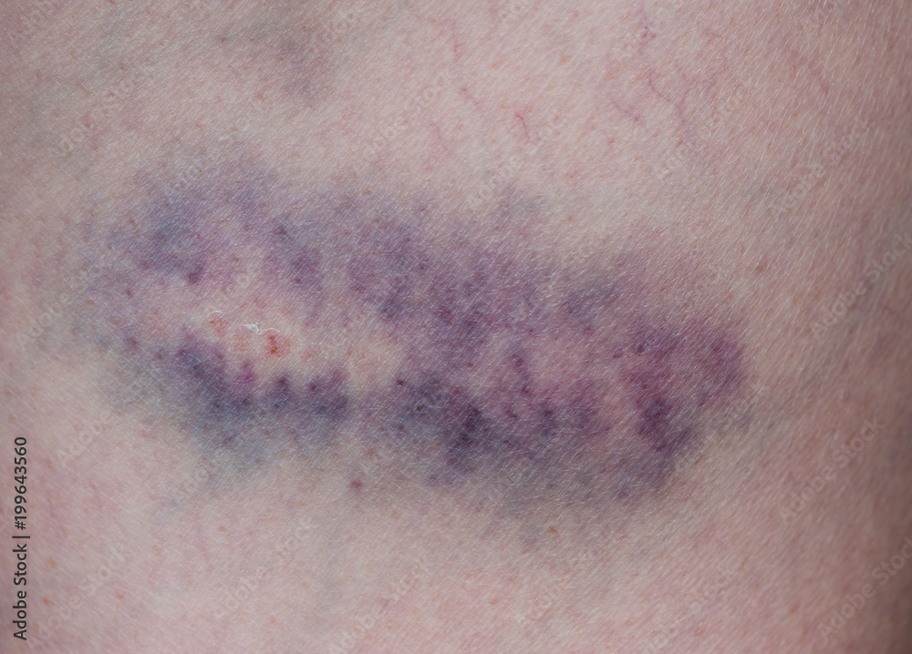 Fototapeta premium bruise injury on young woman thigh