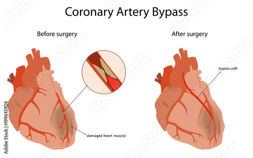 Coronary artery bypass, medical flat vector illustration. Damaged heart muscle, blocked artery, bypass craft.