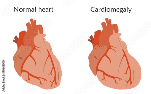 Cardiomegaly. Enlarged and normal heart muscles. Anatomy flat illustration. Colorful image, white background.