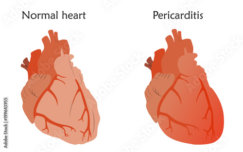 Pericarditis. Inflammation of the pericardium. Damaged and normal heart muscles. Anatomy flat illustration. Colorful image, white background.