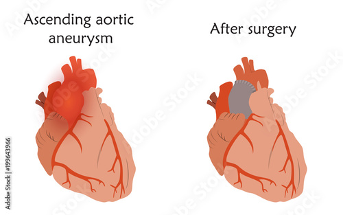 Ascending aortic aneurysm before and after repair. Tube graft and damaged heart muscle. Anatomy flat illustration. Colorful image, white background.