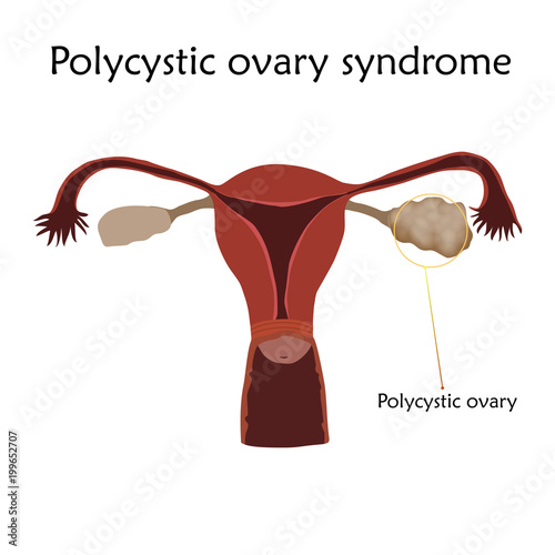 Polycystic ovary syndrome. Human realistic uterus. Anatomy flat illustration with specification. Colored image, white background. Gynecological diseases.