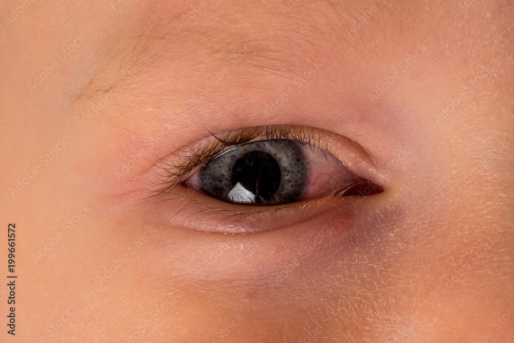 Obraz premium Child with allergy, conjunctivitis his eyes. Sick little boy. Closeup of irritated or infected red bloodshot eye - purulent bacterial conjunctivitis.