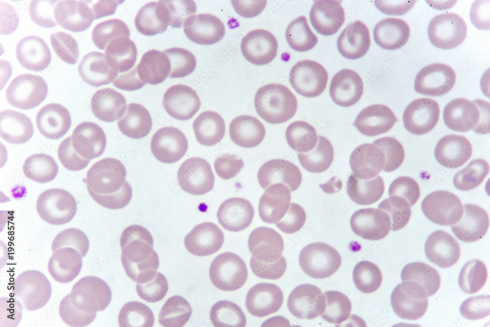 Target cells with abnormal red blood cells from anemia patient, analyze by microscope